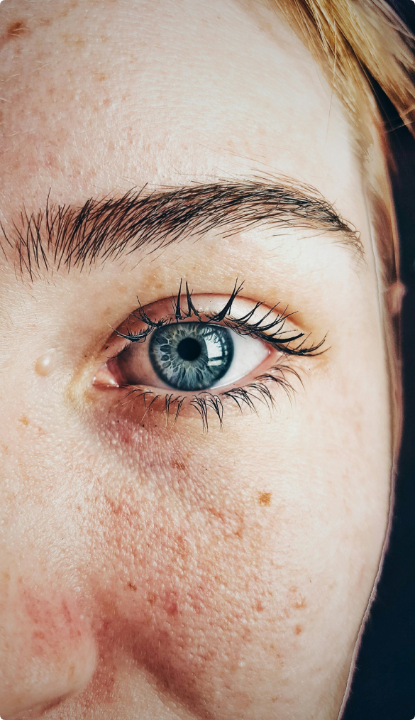 What To Expect After Cataract Surgery